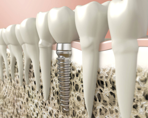 Dental implant