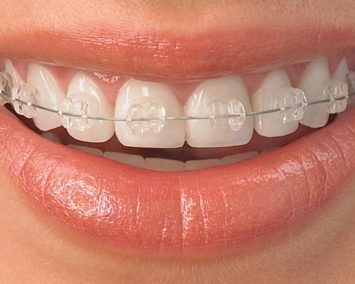 straighten-teeth-with-ICE-ceramic-braces2 (1)